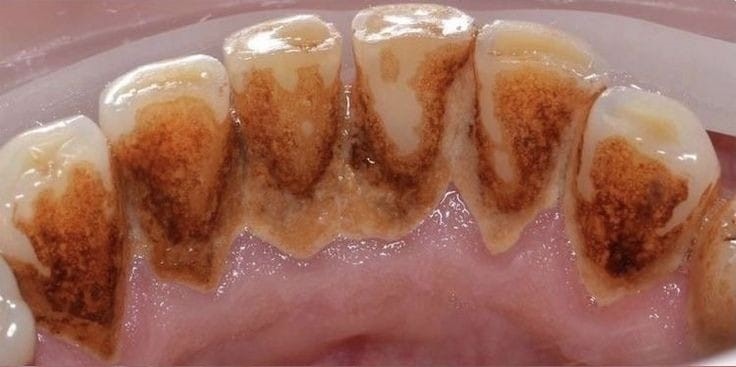 teeth 1 Teeth after cleaning
