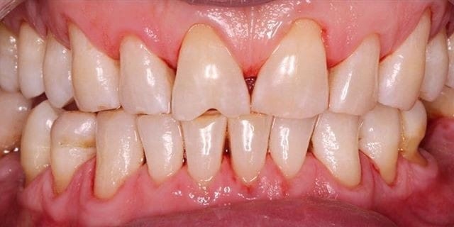 teeth 3 teeth 4