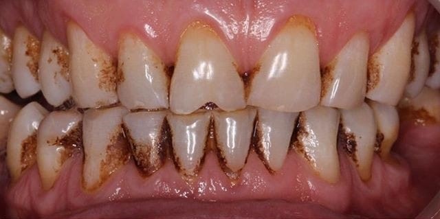 teeth 3 teeth 4
